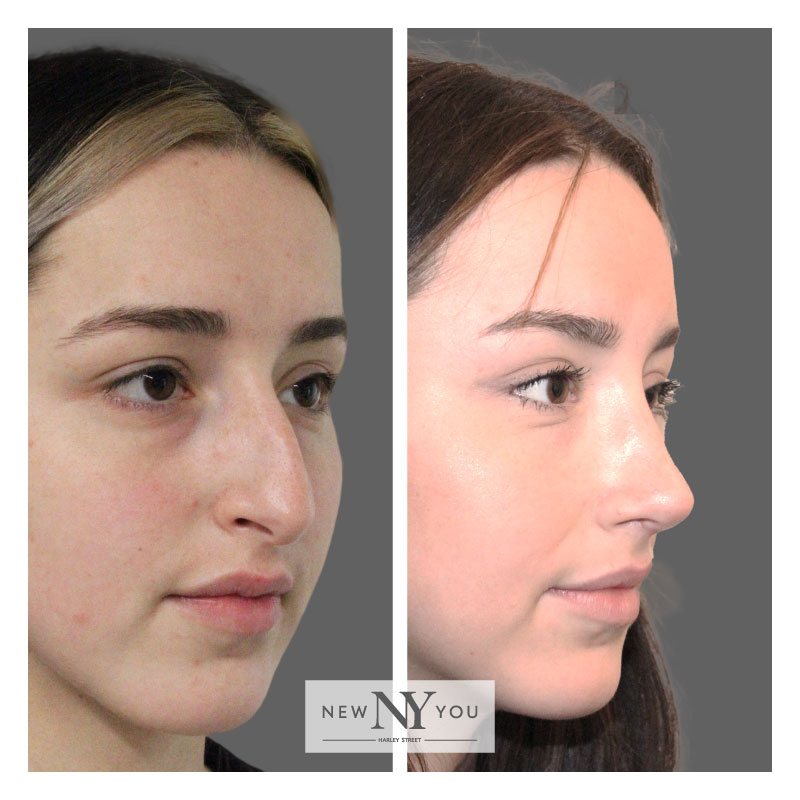 Ultrasonic Rhinoplasty New You Harley Street