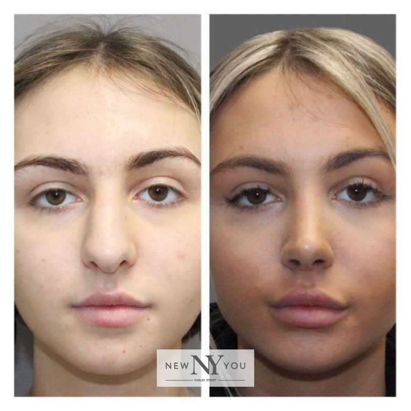 Ultrasonic Rhinoplasty New You Harley Street