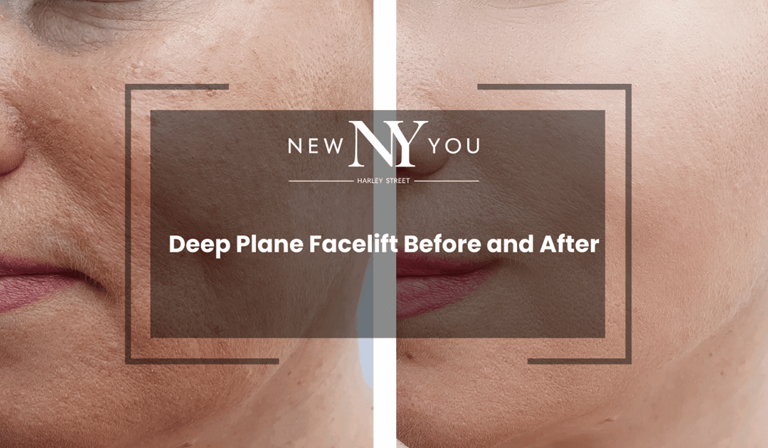 Deep Plane Facelift Before and After