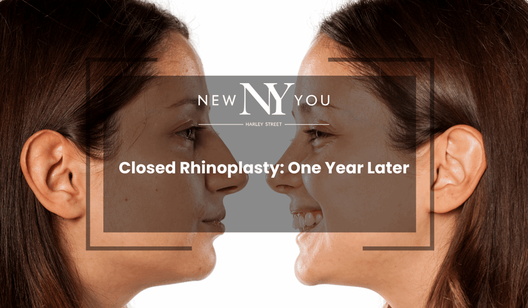 Closed Rhinoplasty: One Year Later