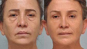 Facelifts: A Comprehensive Guide to Rejuvenating Your Appearance — New You Harley Street