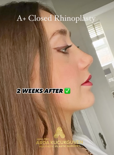 2 week rhinoplasty