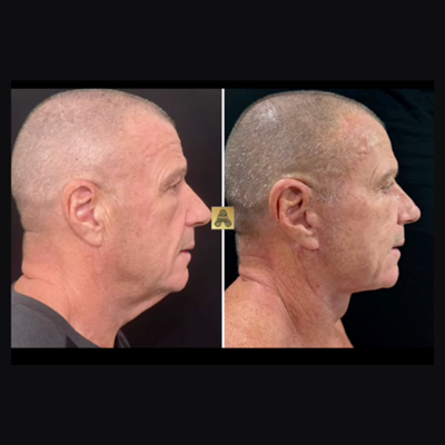 Neck Lift Before After Image 111