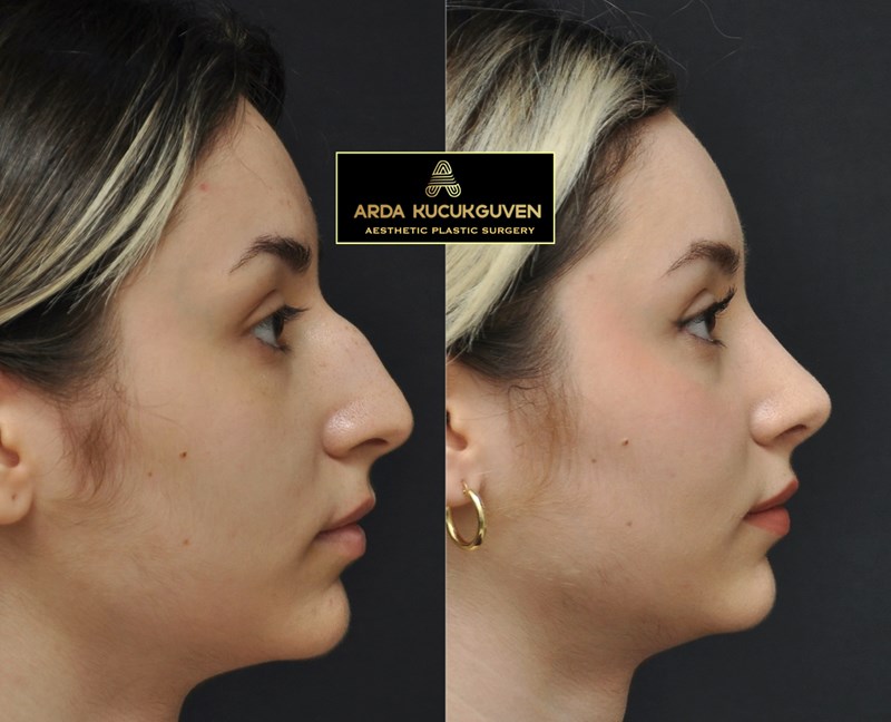 Open Rhinoplasty