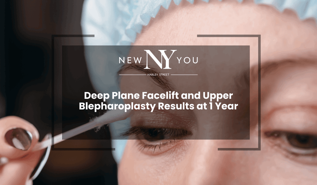 Deep Plane Facelift and Upper Blepharoplasty Results at 1 Year