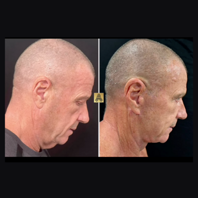 Neck Lift Before After Image 112