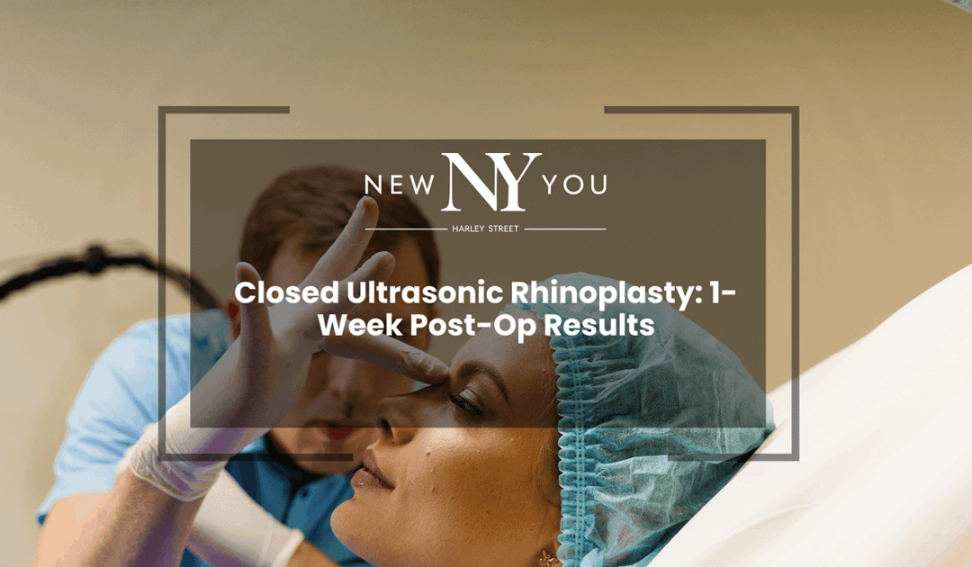 Closed Ultrasonic Rhinoplasty: 1-Week Post-Op Results