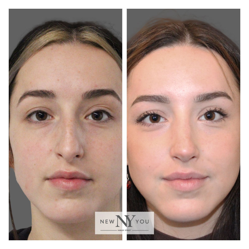 Ultrasonic Rhinoplasty New You Harley Street